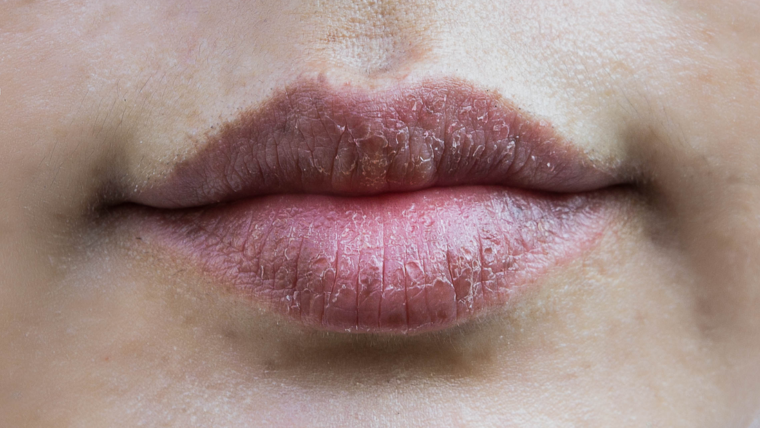 Natural Ways to Fix Dry Chapped Lips | Tips at The GOOD LIFE