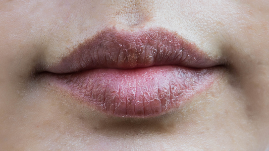 Natural Ways to Fix Dry Chapped Lips | Tips at The GOOD LIFE